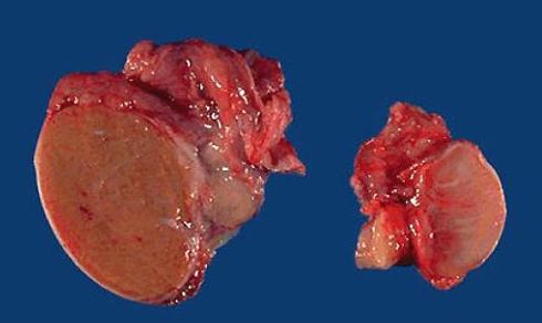 Anabolic steroid heart failure